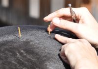Lokalisation der Akupunkturpunkte und Nadeln